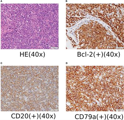 Radiotherapy for Non-Hodgkin’s lymphoma with cardiac infiltration: A case report